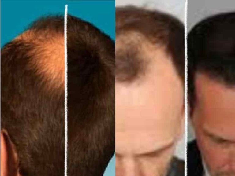 Hair Transplant Cost: What You Need to Know About Hair Transplants and Hairline Restoration