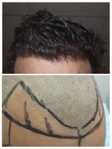 Before After results of Hair Transplant at Face Off Official