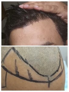 Before After results of Hair Transplant at Face Off Official