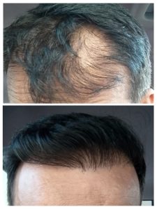 Before After results of Hair Transplant at Face Off Official