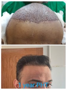 Before After results of hair transplant procedure at face off official