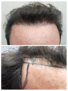Before-After Hair Transplant picture of a client at face off official